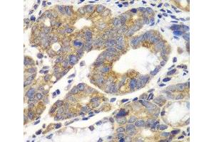 Immunohistochemistry of paraffin-embedded Human gastric cancer using PFKM Polyclonal Antibody at dilution of 1:100 (40x lens). (PFKM antibody)