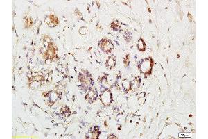 Formalin-fixed and paraffin embedded human breast cancer labeled with Anti-Phospho-Ack1(Tyr284)Polyclonal Antibody, Unconjugated  at 1:200 followed by conjugation to the secondary antibody and DAB staining (TNK2 antibody  (pTyr284))