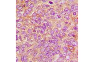 Immunohistochemical analysis of DFF45 staining in human breast cancer formalin fixed paraffin embedded tissue section. (DFFA antibody  (Center))