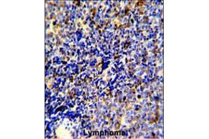 Formalin-fixed and paraffin-embedded human lymphoma reacted with MERTK Antibody, which was peroxidase-conjugated to the secondary antibody, followed by DAB staining. (MERTK antibody)
