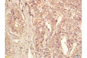 Formalin-fixed and paraffin embedded human lung carcinoma labeled with Rabbit Anti-eIF4ENIF1 Polyclonal Antibody, Unconjugated (ABIN2173808) at 1:200 followed by conjugation to the secondary antibody and DAB staining