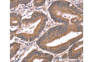 Immunohistochemistry of Human liver cancer using HRG Polyclonal Antibody at dilution of 1:50