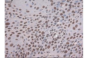 Immunohistochemical staining of paraffin-embedded Adenocarcinoma of colon tissue using anti-NOTCH1mouse monoclonal antibody. (Notch1 antibody  (AA 2300-2556))