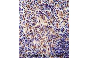 TIGD3 antibody (C-term) immunohistochemistry analysis in formalin fixed and paraffin embedded human hodgkin lymphoma followed by peroxidase conjugation of the secondary antibody and DAB staining. (TIGD3 antibody  (C-Term))