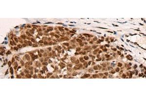 Immunohistochemistry of paraffin-embedded Human thyroid cancer tissue using HGH1 Polyclonal Antibody at dilution of 1:45(x200) (FAM203B antibody)