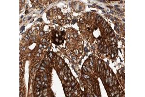 ABIN6266876 at 1/100 staining human Stomach cancer tissue sections by IHC-P.