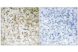 Immunohistochemistry analysis of paraffin-embedded human liver carcinoma tissue using TAF5 antibody. (TAF5 antibody  (Internal Region))