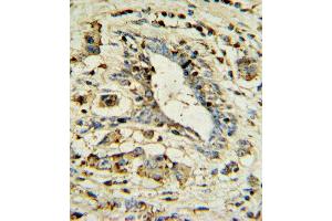 APOL1 Antibody IHC analysis in formalin fixed and paraffin embedded human breast carcinoma followed by peroxidase conjugation of the secondary antibody and DAB staining.