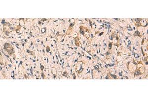 Immunohistochemistry of paraffin-embedded Human liver cancer tissue using CRYM Polyclonal Antibody at dilution of 1:65(x200) (CRYM antibody)