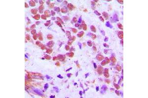 Immunohistochemical analysis of RFX3 staining in human breast cancer formalin fixed paraffin embedded tissue section. (RFX3 antibody  (C-Term))