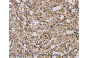 Immunohistochemistry of Human gastric cancer using DCN Polyclonal Antibody at dilution of 1:30 (Decorin antibody)