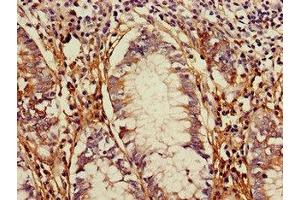 Immunohistochemistry of paraffin-embedded human colon cancer using ABIN7172274 at dilution of 1:100 (TLR5 antibody  (AA 682-850))