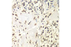 Immunohistochemistry of paraffin-embedded human kidney cancer using USP7/HAUSP antibody (ABIN6132279, ABIN6150031, ABIN6150033 and ABIN6217612) at dilution of 1:200 (40x lens). (USP7 antibody  (AA 206-1102))