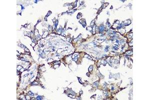 Immunohistochemistry of paraffin-embedded Human lung cancer using MMP16 Polyclonal Antibody at dilution of 1:100 (40x lens). (MMP16 antibody)