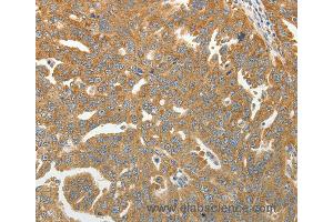 Immunohistochemistry of Human ovarian cancer using RPLP0 Polyclonal Antibody at dilution of 1:40