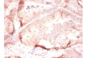 Immunohistochemistry of paraffin-embedded human colon cancer using ABIN7148243 at dilution of 1:50 (COL4a2 antibody  (AA 1493-1712))