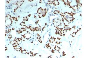 Formalin-fixed, paraffin-embedded human Thyroid stained with PAX8 Recombinant Mouse Monoclonal Antibody (rPAX8/1492).