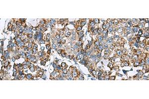 Immunohistochemistry of paraffin-embedded Human liver cancer tissue using PRELID3B Polyclonal Antibody at dilution of 1:90(x200) (SLMO2 antibody)