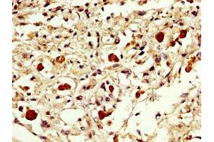 IHC image of ABIN7152301 diluted at 1:300 and staining in paraffin-embedded human melanoma performed on a Leica BondTM system. (EXOSC1 antibody  (AA 587-762))