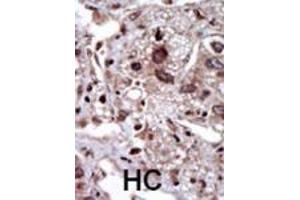 Formalin-fixed and paraffin-embedded human cancer tissue reacted with the primary antibody, which was peroxidase-conjugated to the secondary antibody, followed by DAB staining. (STK39 antibody  (AA 346-376))