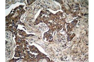 Immunohistochemical analysis of paraffin-embedded human lung carcinoma tissue, using HER2 (Phospho-Tyr1248) Antibody.
