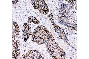 Anti-Peroxiredoxin 3 antibody, IHC(P) IHC(P): Human Lung Cancer Tissue (Peroxiredoxin 3 antibody  (C-Term))