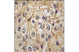 Formalin-fixed and paraffin-embedded human hepatocarcinoma tissue reacted with EphA7 antibody, which was peroxidase-conjugated to the secondary antibody, followed by DAB staining. (EPH Receptor A7 antibody)