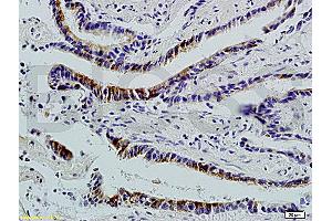 Formalin-fixed and paraffin-embedded : human colon carcinoma labeled with Rabbit Anti-Integrin ? (ITGAV/ITGB1 antibody)