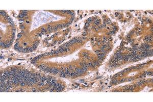 Immunohistochemistry of paraffin-embedded Human colon cancer tissue using S100A13 Polyclonal Antibody at dilution 1:40 (S100A13 antibody)