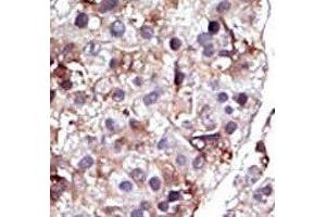 IHC analysis of FFPE human hepatocarcinoma tissue stained with the SPHK2 antibody (SPHK2 antibody  (AA 1-30))