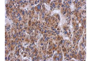 IHC-P Image Immunohistochemical analysis of paraffin-embedded human hepatoma, using PTS, antibody at 1:500 dilution. (PTS antibody)
