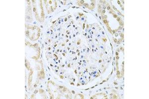Immunohistochemistry of paraffin-embedded human kidney cancer using CBFB Antibody (ABIN6130041, ABIN6138000, ABIN6138001 and ABIN6220926) at dilution of 1:200 (40x lens).