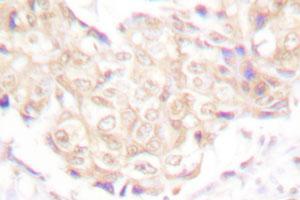 Immunohistochemical analysis of paraffin-embedded human breast cancer tissue using UBR5 polyclonal antibody . (UBR5 antibody)