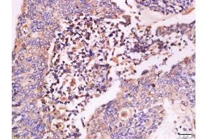 Paraformaldehyde-fixed, paraffin embedded human colon carcinoma tissue, Antigen retrieval by boiling in sodium citrate buffer(pH6) for 15min, Block endogenous peroxidase by 3% hydrogen peroxide for 30 minutes, Blocking buffer (normal goat serum) at 37°C for 20min, Antibody incubation with Rabbit Anti-IFN-beta Polyclonal Antibody, Unconjugated  at 1:500 overnight at 4°C, followed by a conjugated secondary and DAB staining (IFNB1 antibody  (AA 101-187))