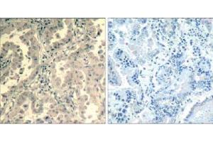 Immunohistochemical analysis of paraffin-embedded human lung carcinoma tissue using stat2 (Ab-690) Antibody (E021536). (STAT2 antibody)