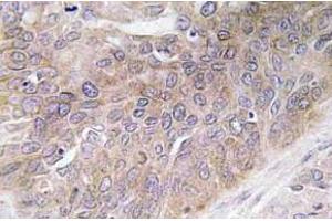 Immunohistochemistry (IHC) analyzes of VEGF-D antibody in paraffin-embedded human lung carcinoma tissue. (VEGFD antibody)
