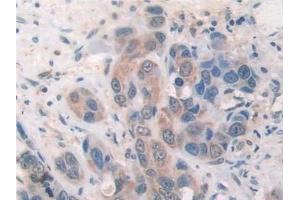 Detection of SOCS2 in Human Breast cancer Tissue using Polyclonal Antibody to Suppressors Of Cytokine Signaling 2 (SOCS2) (SOCS2 antibody  (AA 1-198))