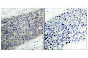 Immunohistochemical analysis of paraffin-embedded human breast carcinoma tissue using LIMK2(Phospho-Thr505) Antibody(left) or the same antibody preincubated with blocking peptide(right). (LIMK2 antibody  (pThr505))