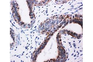 IHC-P: PI3K antibody testing of human breast cancer tissue (PIK3R1 antibody  (AA 447-461))