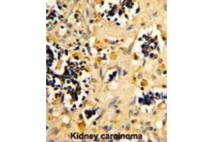 Formalin-fixed and paraffin-embedded human kidney carcinoma reacted with NDUFS4 Antibody (C-term), which was peroxidase-conjugated to the secondary antibody, followed by DAB staining.