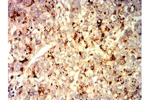 Immunohistochemical analysis of paraffin-embedded liver cancer tissues using GPC3 mouse mAb with DAB staining. (Glypican 3 antibody  (AA 55-200))