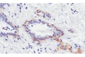 Immunohistochemical staining of paraffin embedded human breast tissue using anti-erbB-2 antibody. (Recombinant ErbB2/Her2 (Trastuzumab Biosimilar) antibody)