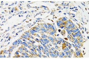 Immunohistochemistry of paraffin-embedded Human esophageal cancer using SH2B1 Polyclonal Antibody at dilution of 1:100 (40x lens).