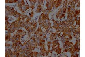 IHC image of ABIN7127799 diluted at 1:100 and staining in paraffin-embedded human breast cancer performed on a Leica BondTM system. (Recombinant S1A9 antibody)