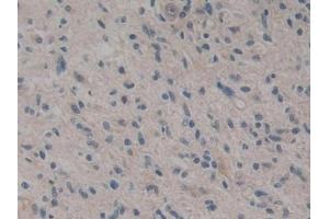 Detection of CARD9 in Human Glioma Tissue using Polyclonal Antibody to Caspase Recruitment Domain Family, Member 9 (CARD9) (CARD9 antibody  (AA 26-283))