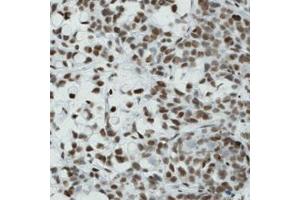 Immunohistochemical staining (Formalin-fixed paraffin-embedded sections) of human stomach cancer with CTCF monoclonal antibody, clone CL0307  shows nuclear immunoreactivity in tumor cells. (CTCF antibody)