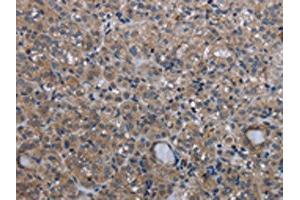 The image on the left is immunohistochemistry of paraffin-embedded Human thyroid cancer tissue using ABIN7130197(MCM3AP Antibody) at dilution 1/30, on the right is treated with fusion protein. (GANP antibody)