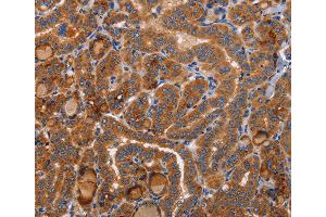 Immunohistochemistry of Human colon cancer using BMP6 Polyclonal Antibody at dilution of 1:40 (BMP6 antibody)