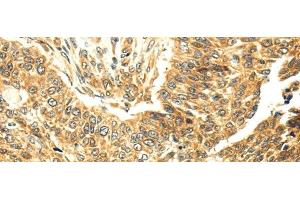 Immunohistochemistry of paraffin-embedded Human lung cancer tissue using SERPINA12 Polyclonal Antibody at dilution 1:40 (SERPINA12 antibody)