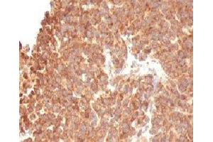 Formalin-fixed, paraffin-embedded human melanoma stained with TOP1MT antibody (TOP1MT/488).